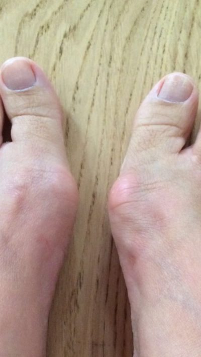 Hallux Valgus